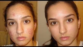 A true miracle How I got rid of my acne Daily skincare routine [upl. by Idaf]