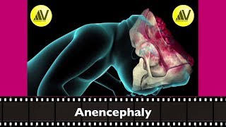 Anencephaly Explained [upl. by Rebecca]