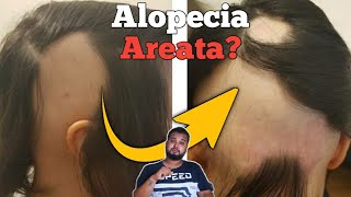 Alopecia Areata  Symptoms Causes And Regrowth Treatments  HIndI   Sourav Mridha [upl. by Langbehn192]