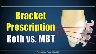 Using Roth and MBT brackets [upl. by Milena]