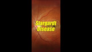 Stargardt disease [upl. by Aramo289]