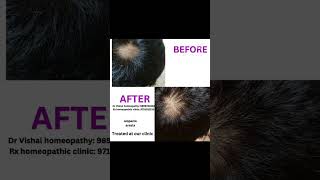 Alopecia areata treated with homeopathy at our clinic alopecia hairloss hairfall [upl. by Anidal]