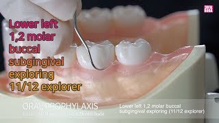 Lower left 12 molar buccal subgingival exploring 1112 explorer [upl. by Hanny]