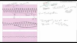 Comparing ventricular rhythms [upl. by Margo]