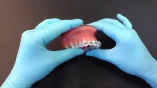 How to use orthodontic wax [upl. by Christye910]