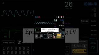 Non Shockable Rhythms PEAPulseless Electrical Activity and Asystole [upl. by Nosned]