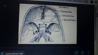 CSF RHINORRHEA important seq with major stuff part 1 [upl. by Dhar]