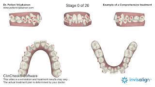 ClinCheck 3D treatment plan of an Invisalign Comprehensive Treatment [upl. by Allis728]