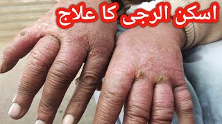 psoriasis treatmentskin allergypsoriasis signpsoriasis [upl. by Nnaxor357]