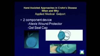 Hand Assisted Approaches in Crohn�s Disease Eric G Weiss MD [upl. by Dreddy]