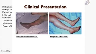 Phlegmasia Cerulea Dolens VS Phlegmasia Alba Dolens  Deep Vein Thrombosis  Signs and Symptoms [upl. by Rehpotsrihc]