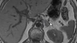 Adrenal adenoma in and out of phase imaging [upl. by Hgielrebmik]