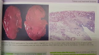 Chronic Pyelonephritis  SPECIAL PATHOLOGY [upl. by Lowis]