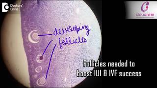 How many follicles do you need to boost IUI or IVF success Dr Radhika Seth of Cloudnine Hospitals [upl. by Alleras394]