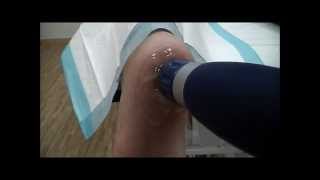 Plantar Fasciitis [upl. by Vita]