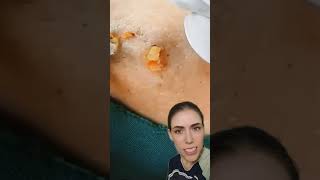 Blackheads Removal  Acne Treatment and Very Satisfying Satisfying Pimple pop blackheads [upl. by Eirhtug]