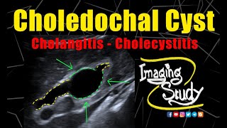 Choledochal Cyst with Cholangitis amp cholecystitis  Ultrasound  Case 272 [upl. by Struve]