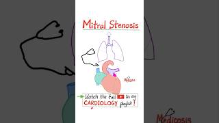 Mitral Stenosis MS  Valvular Heart Diseases VHD Part 2…anatomy mbbs cardio cardiology [upl. by Neelrahs]