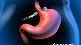 Gastric Band Insertion [upl. by Nyraf]