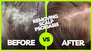 Removing Plaque Scalp Psoriasis  Using The AntiFungal Bundle myhappyscalpcom [upl. by Atinauq]