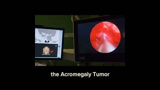 surgery for gh secreting adenoma in patient with mccune albright syndrome with fibrous dysplasia [upl. by Yelahc]