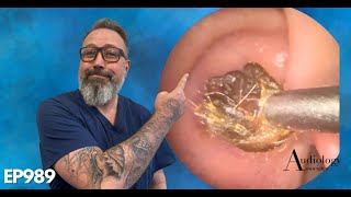 The MOST SATISFYING ring of dry ear wax removal EP989 [upl. by Dorraj103]