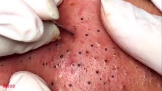 acne treatment how to remove blackheads on the face [upl. by Colis]