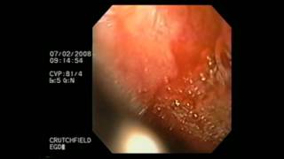 Esophagogastroduodenoscopy [upl. by Elockin]