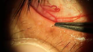 Removing Head Hair Clipping from Inside Eyelid Tear Gland [upl. by Niwrek817]