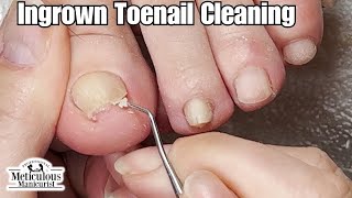 Pincer Toenail Transformation at Home ASMR Relaxing nails satisfying [upl. by Ezechiel]