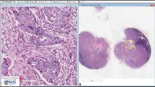 Breast Invasive carcinoma NST with lymph node metastases Microscopy Talking slide [upl. by Kermy]