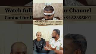 Before amp After Hair Transplant Results in Delhi haircare shorts [upl. by Lawson]