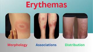 Erythemas Uncovered Insights into Morphology Associations and Distribution [upl. by Acinorej893]