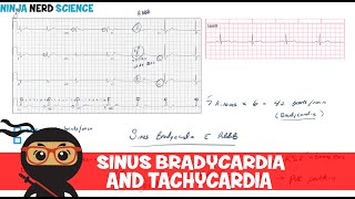 Rate and Rhythm  Sinus Bradycardia and Sinus Tachycardia [upl. by Ximena]