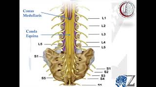 Degenerative Spine 9  Cauda EquinaConus Medullaris Syndromes [upl. by Nwahsyt]