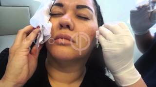 Radiesse Soft Tissue Filler Cheek Augmentation  Filler to Cheeks  Non Invasive Facial Contouring [upl. by Aehtna576]