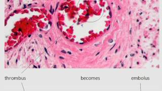 MedDef29 Thrombus vs Embolus [upl. by Shotton638]