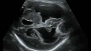 Fetal Medicine Foundation  Porencephalic cyst [upl. by Erdnael477]