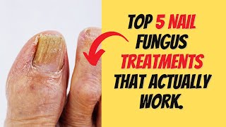 Top 5 Nail Fungus Treatments That Actually Work [upl. by Airottiv]