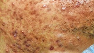 Acné kystiques et enlever les boutons sur le visage  cystic acne extraction [upl. by Onaicnop]