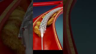 Heart Angioplasty Explained in Animated Video [upl. by Lennor]