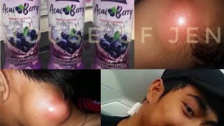 Acai Berry Mixed Fruit Drink Testimony Bukol sa Leeg [upl. by Ynavoeg]