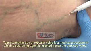 Foam sclerotherapy for treating spider veins and varicose veins [upl. by Wilen]