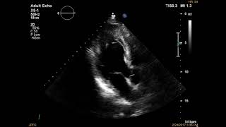 Miocardiopatia hipertrófica apical [upl. by Shutz]