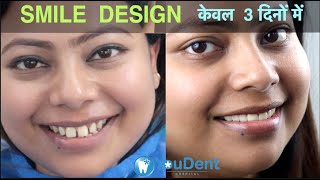 Teeth Gap Treatment in 5 Days I Zirconia Cap I Best Smile Design Dentist in INDIA youdent ​ [upl. by Anayeek]