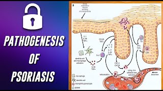 Pathogenesis of Psoriasis  Psoriasis explained  For Postgraduates  DrTVanathi [upl. by Molahs316]