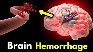 Brain Hemorrhage Symptoms Cause Treatment [upl. by Ole]