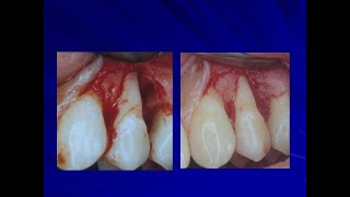 Regenerative periodontal surgery Part 1 Dr Jose Paul [upl. by Gerkman]