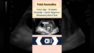 Fetal Anomaly ultrasound cyctic Hygromapregnancyultrasound medical baby [upl. by Nitsugua]