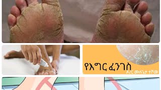 የእግር ፈንገስ ህክምና ና መከላከያ መንገዶች Tinea Pedis dr healthtips ethiopian oromomusic ዶንኪቲውብ [upl. by Bywoods]